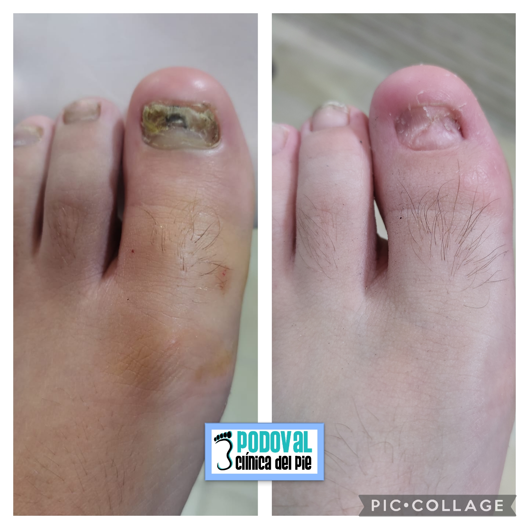ANTES Y DESPUES ALTERACION POR TRAUMATISMO