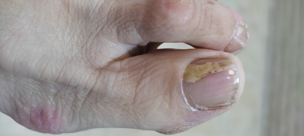 ONICOMICOSIS